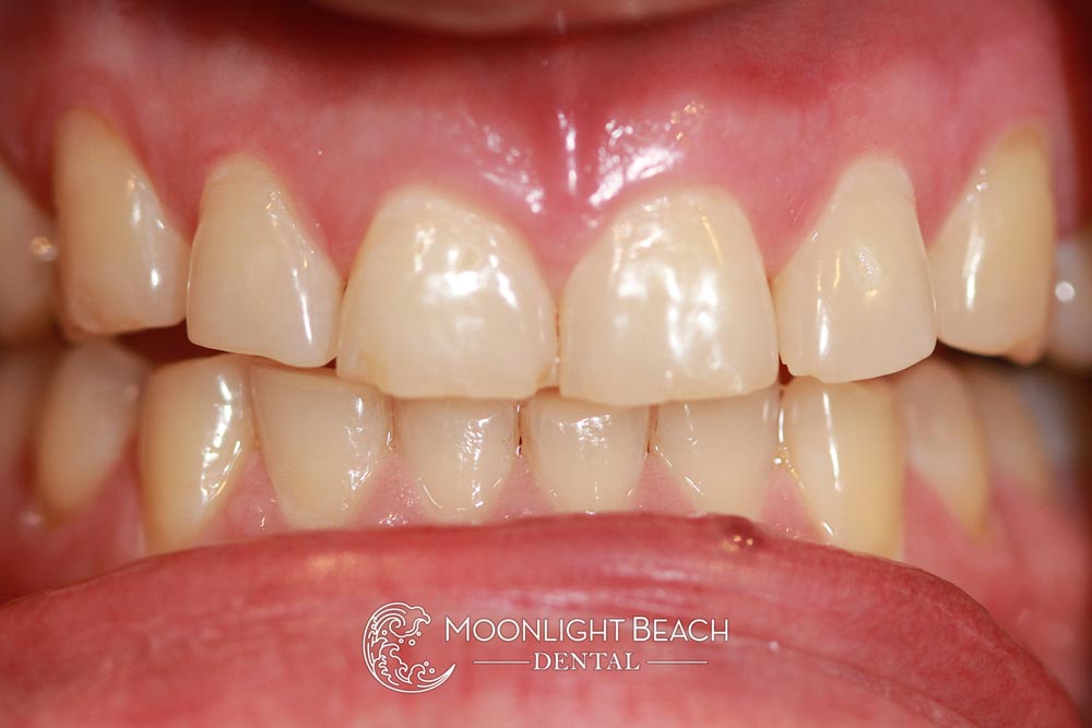 One Year Later: Conservative Smile Makeover