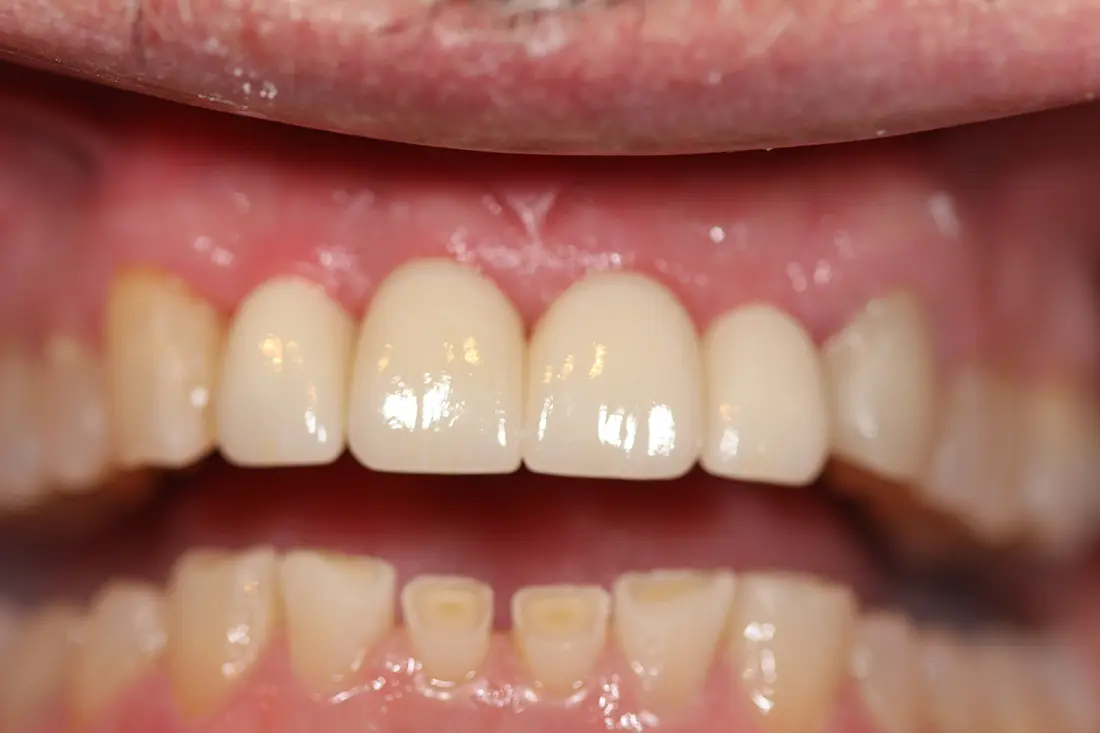 Zirconia Implants