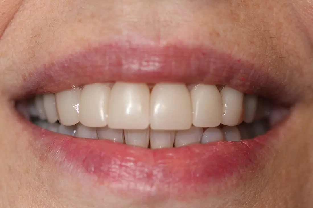 A New Smile with Veneers