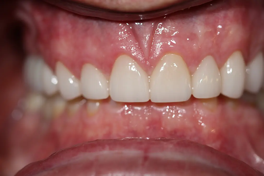 Renewing the Size & Look of Teeth