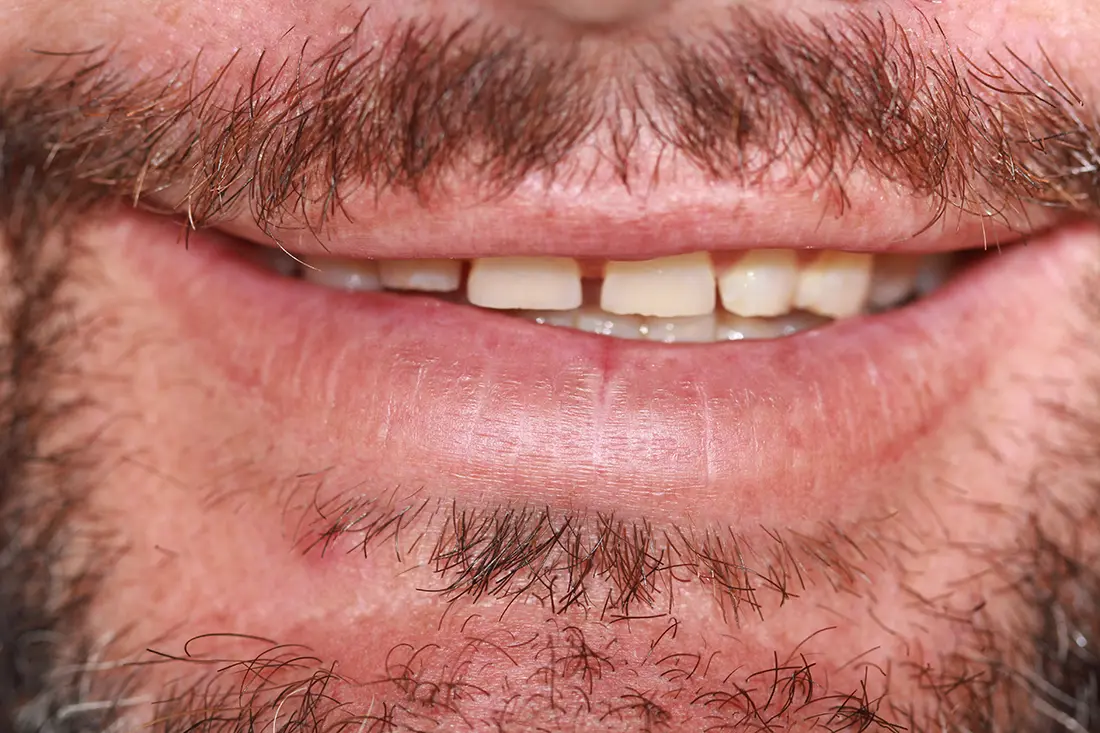 Worn Teeth Restoration