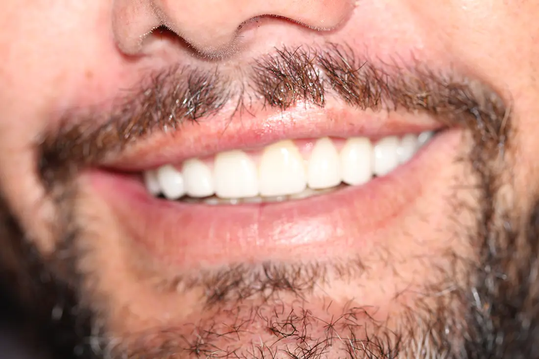 Worn Teeth Restoration