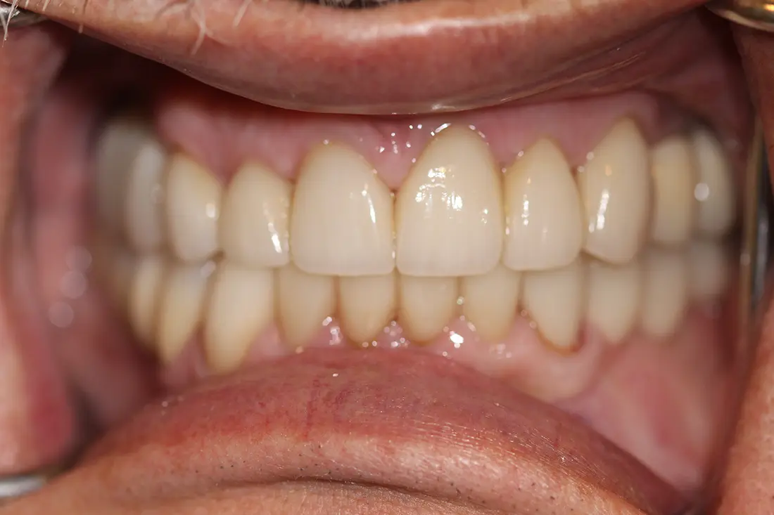 Full Mouth Reconstruction