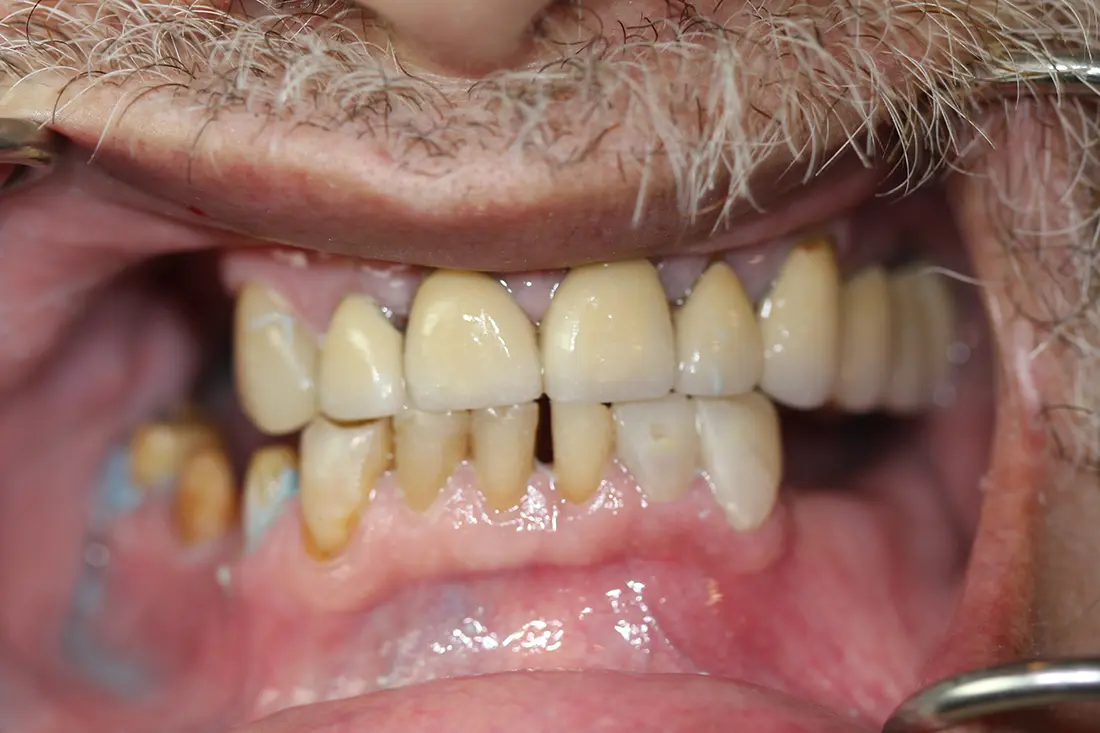 Full Mouth Reconstruction