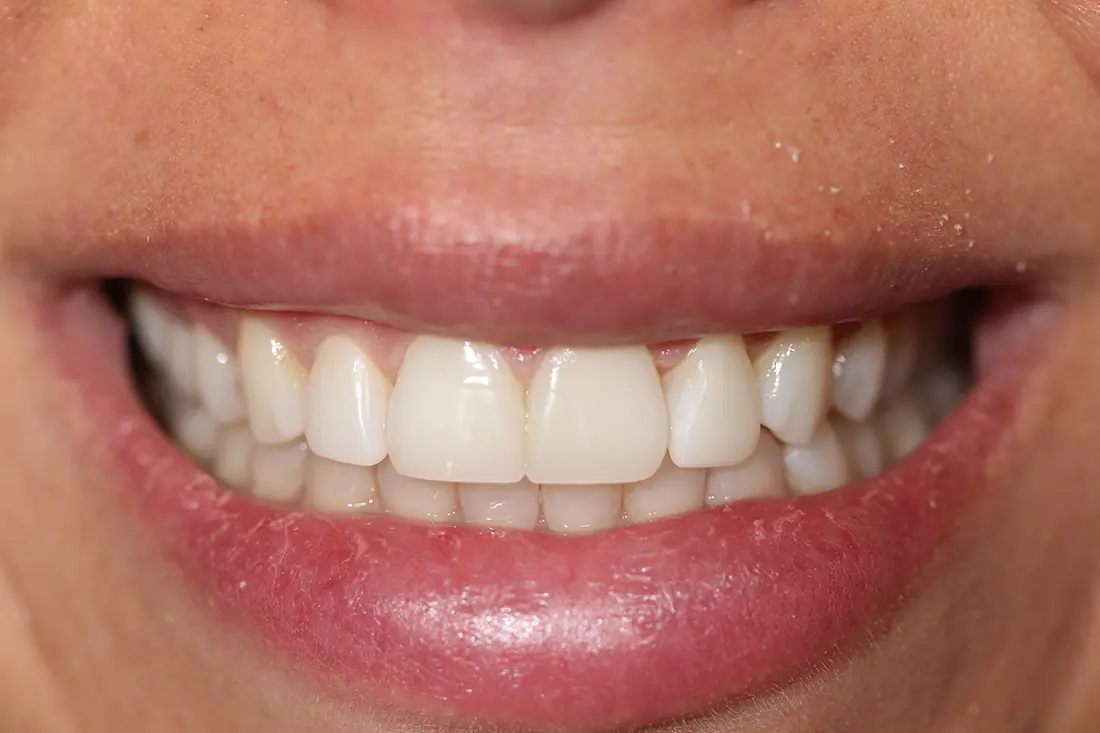 Clear Aligners & Bonding
