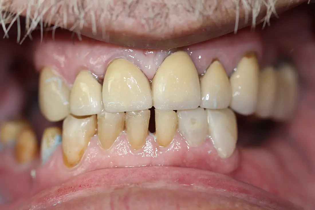 Full Mouth Restoration 