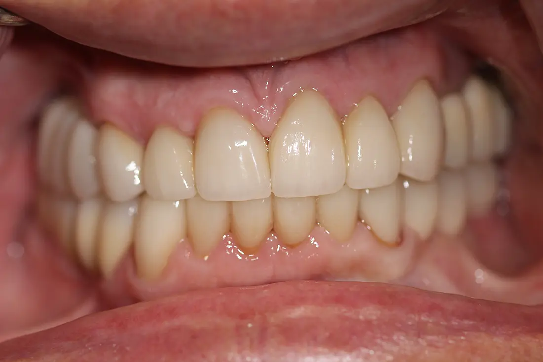 Full Mouth Restoration 