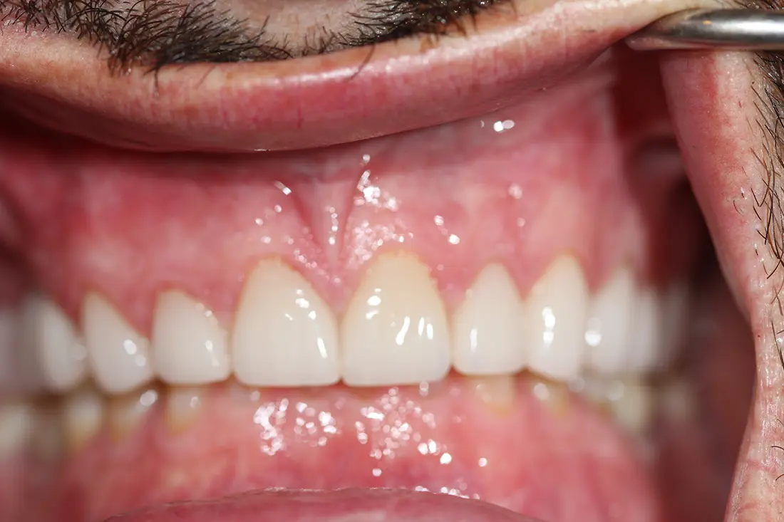 Beautiful Smile Restoration 