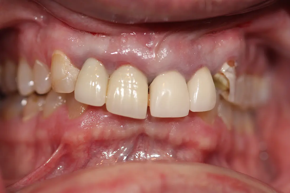 Same-Day Zirconia Implants