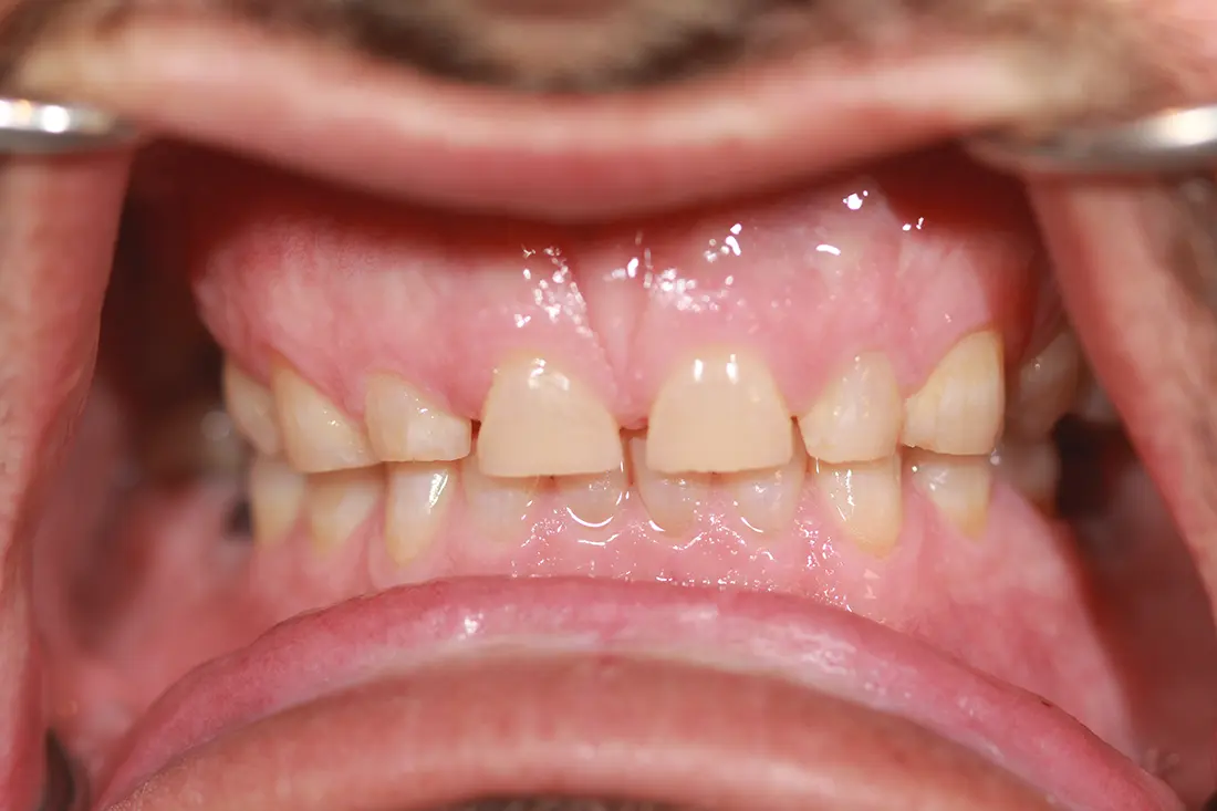 Beautiful Smile Restoration 