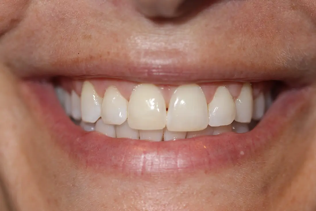 Crown Lengthening with Laser Therapy