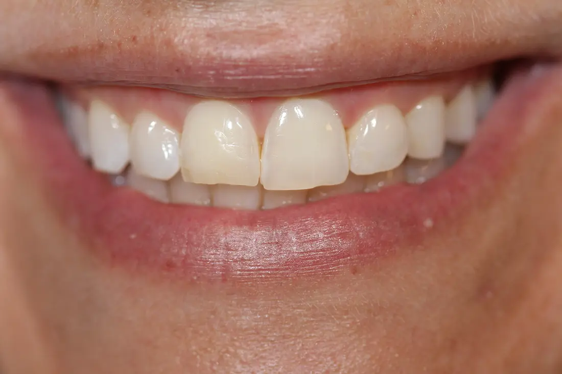 Crown Lengthening with Laser Therapy