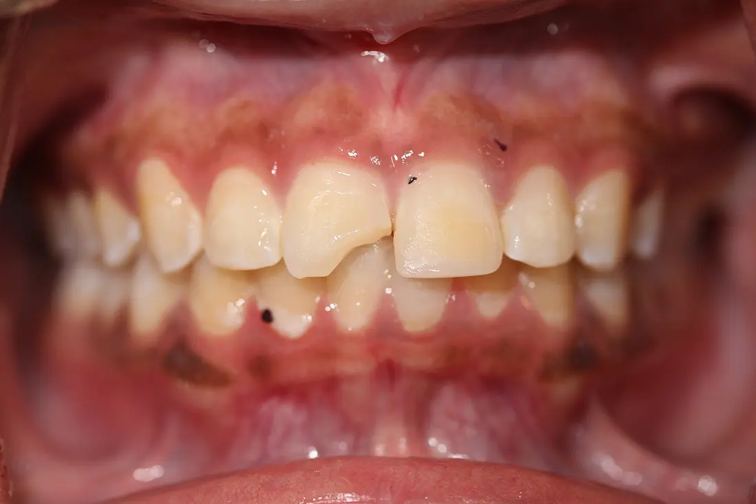 Broken Tooth Restoration