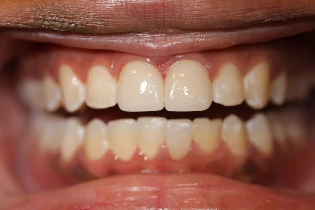 Broken Tooth Restoration