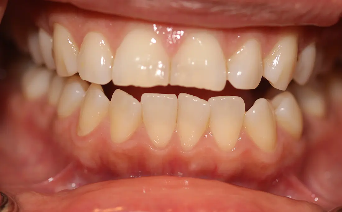 Clear Aligners & Bonding