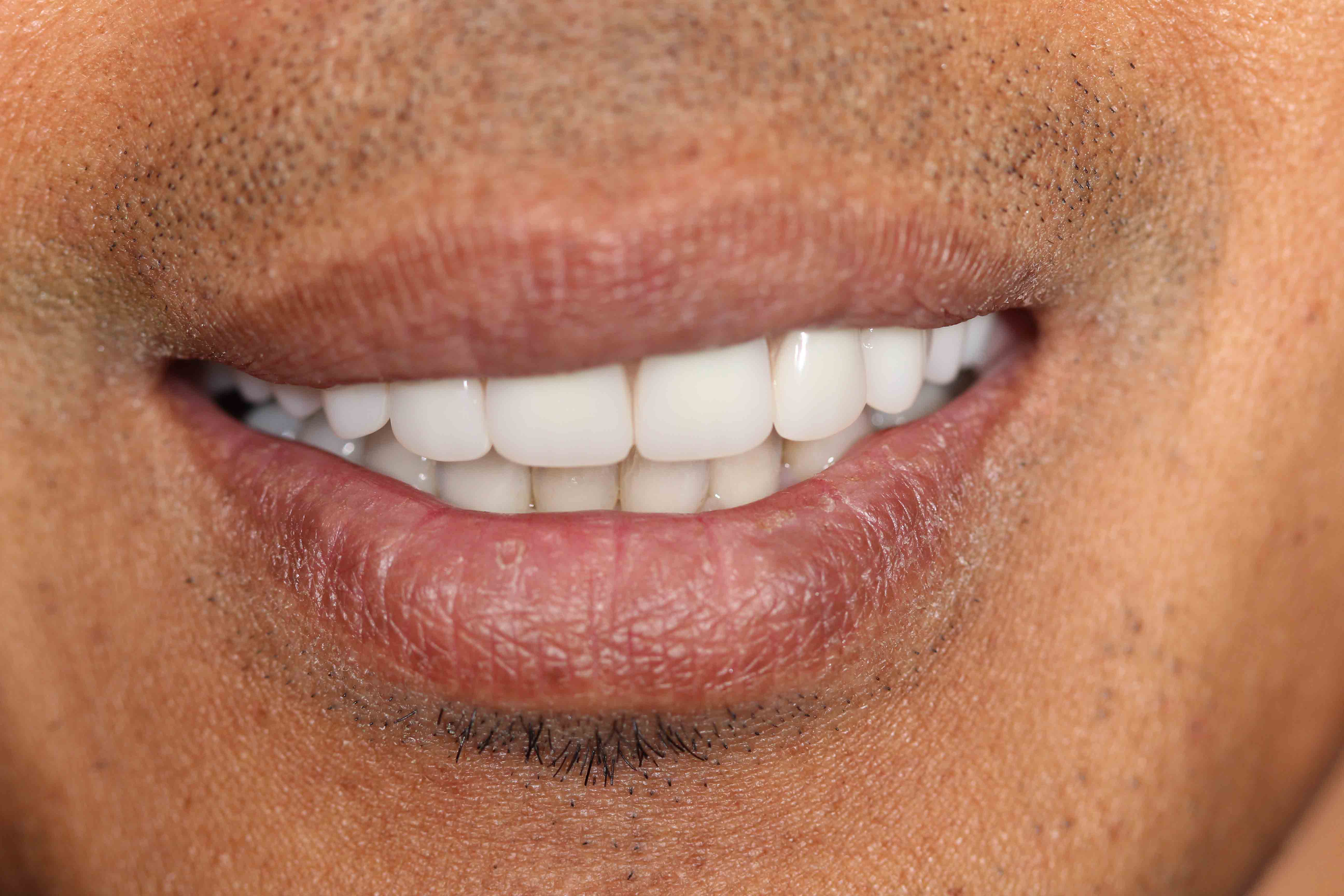 before and after: Implants