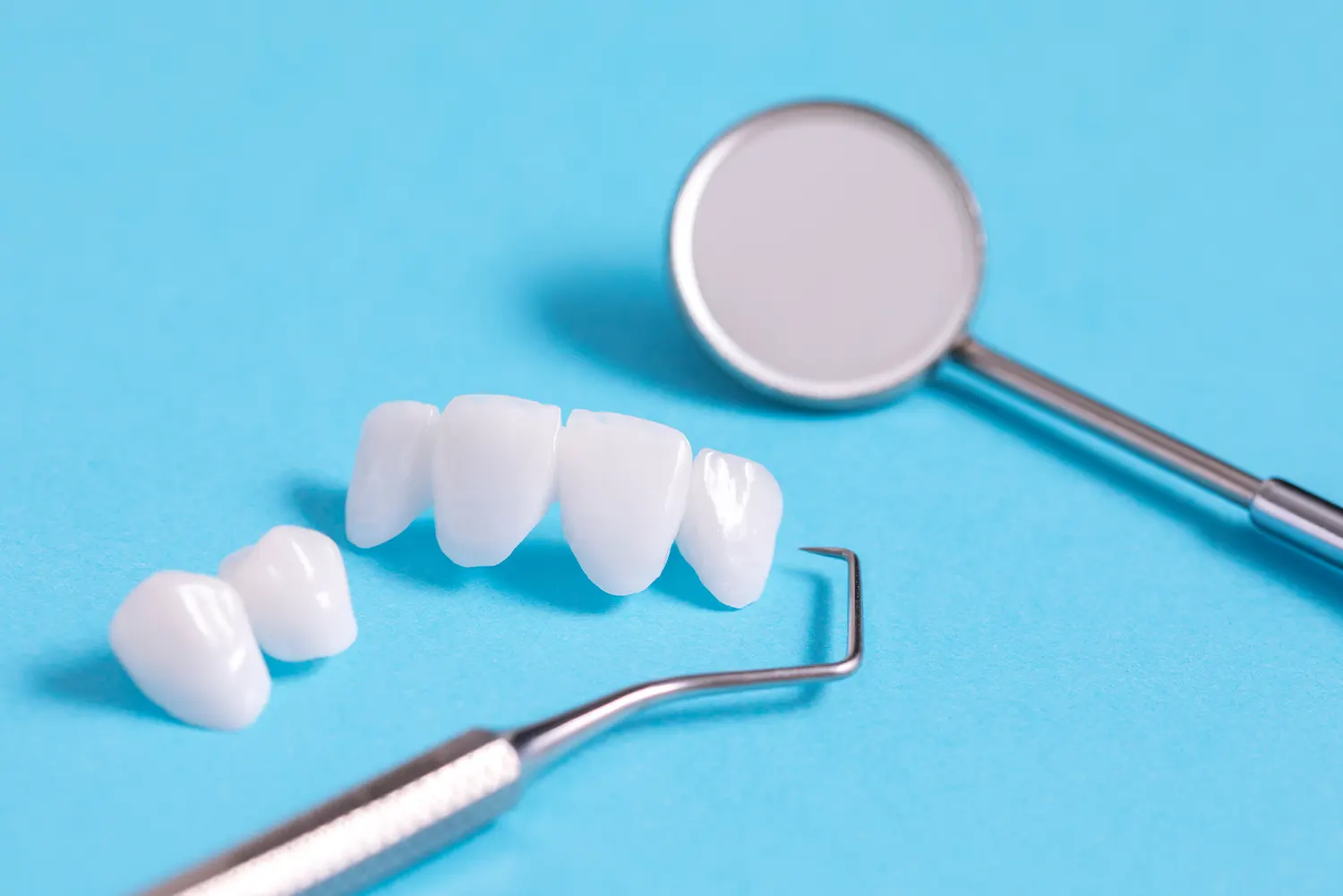 What are Minimal Prep Veneers?