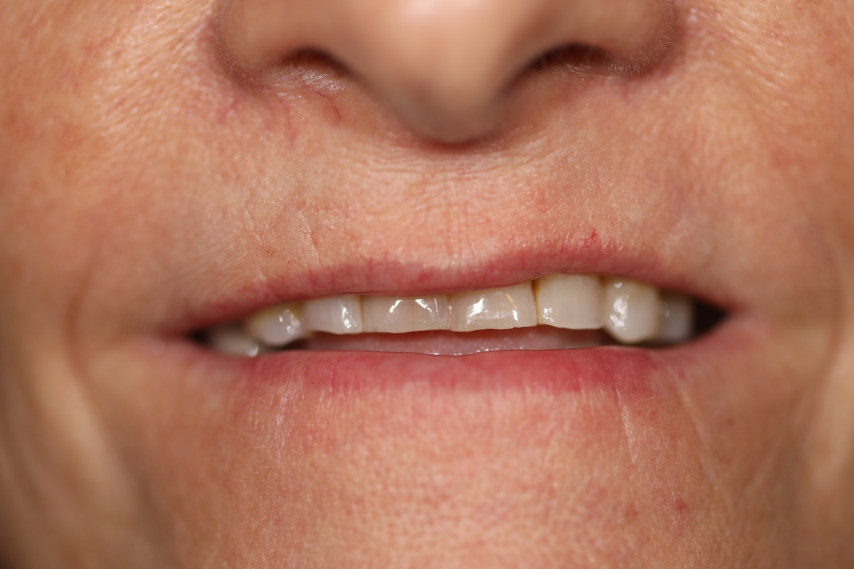 Before & After: Porcelain Veneers Transformation