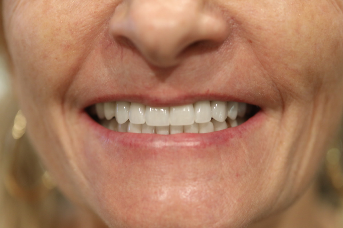 Before & After: Porcelain Veneer Replacement