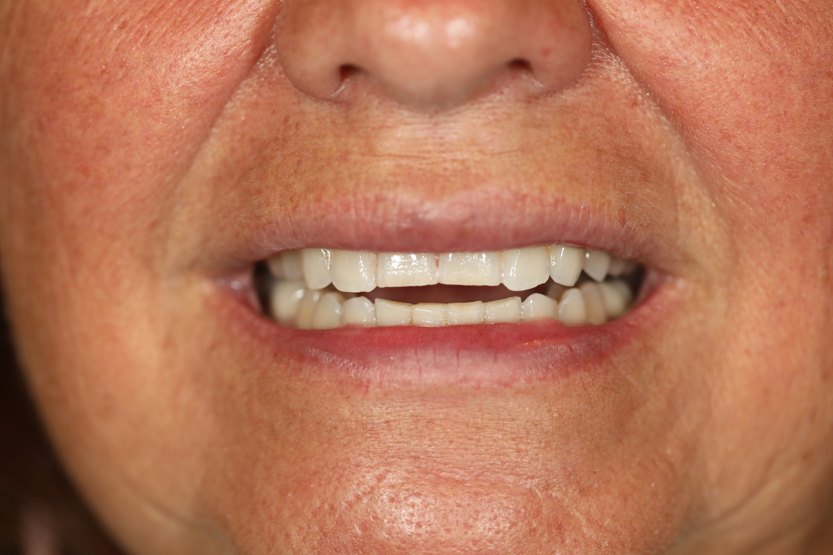 Before & After: Worn Enamel Restoration