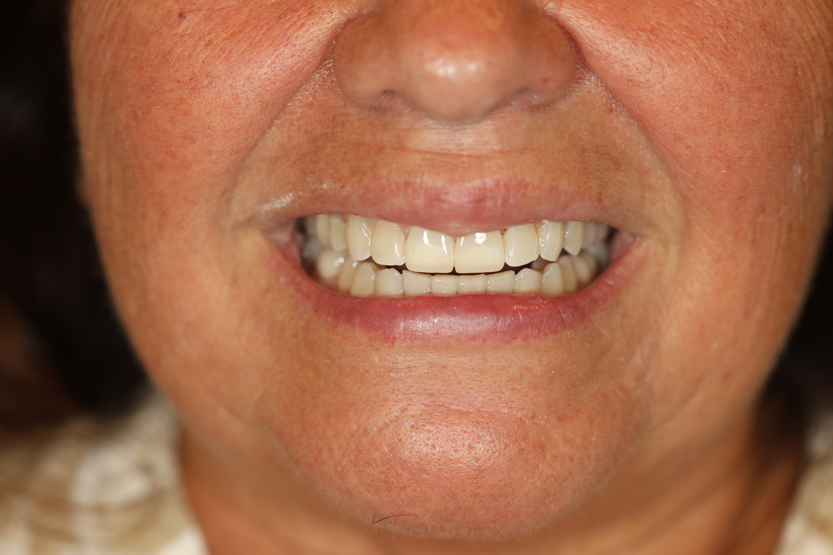 Before & After: Worn Enamel Restoration