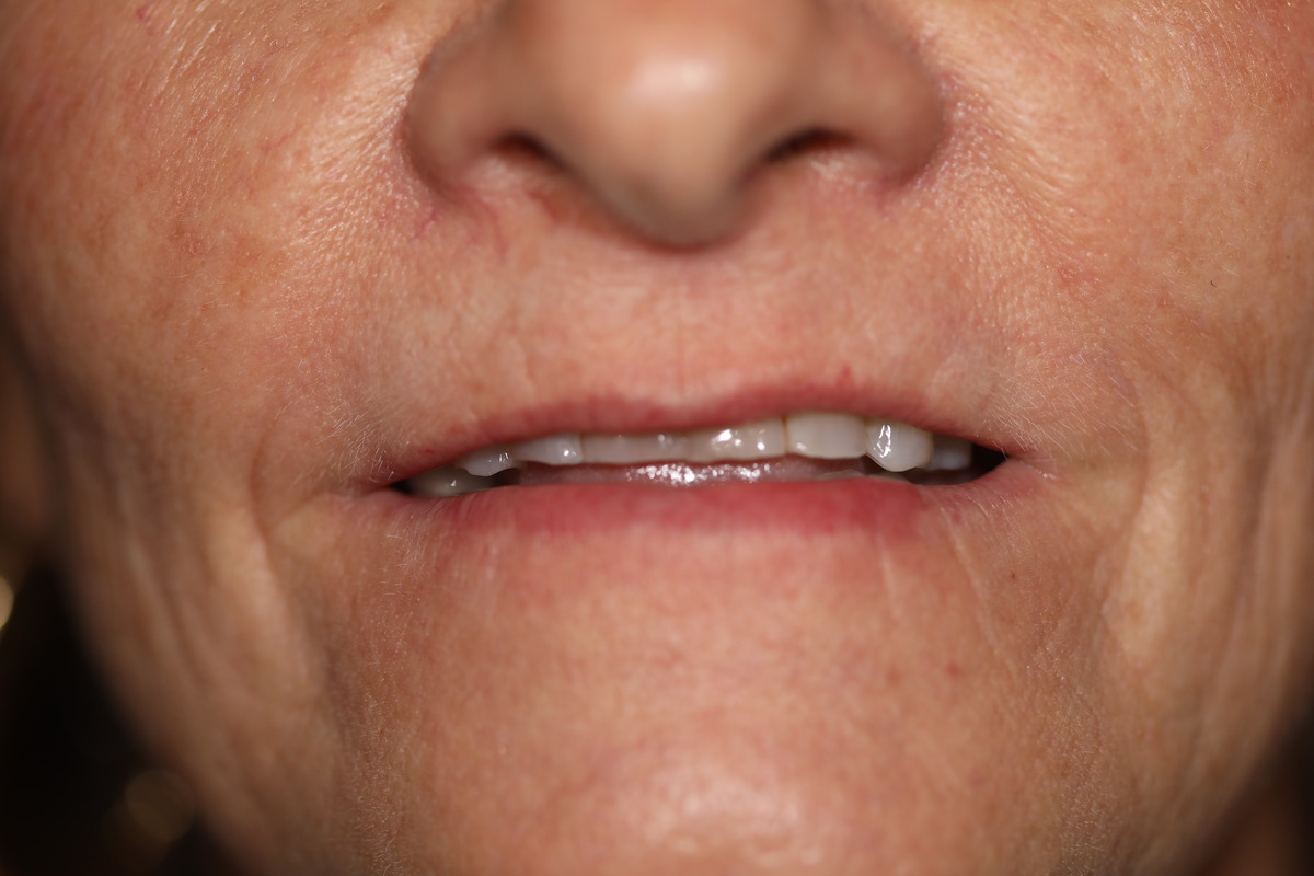 Before & After: Porcelain Veneer Replacement