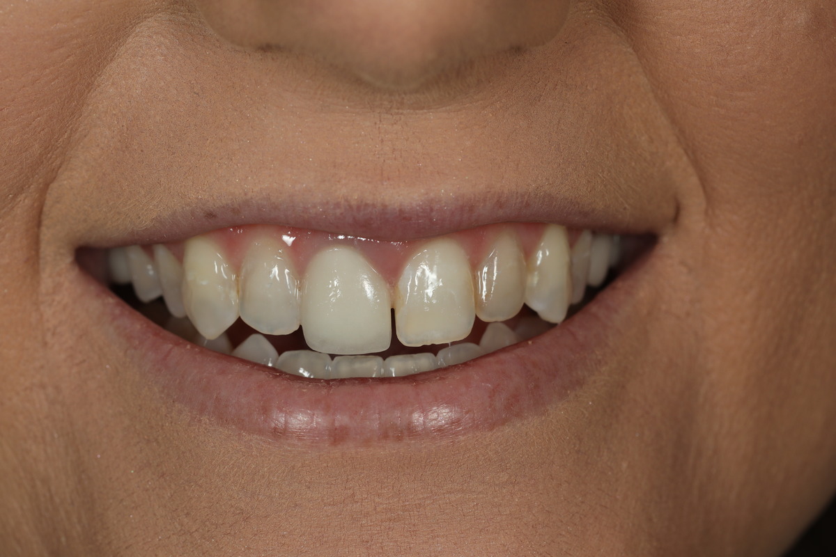 Before & After: Replacing Old Dentistry