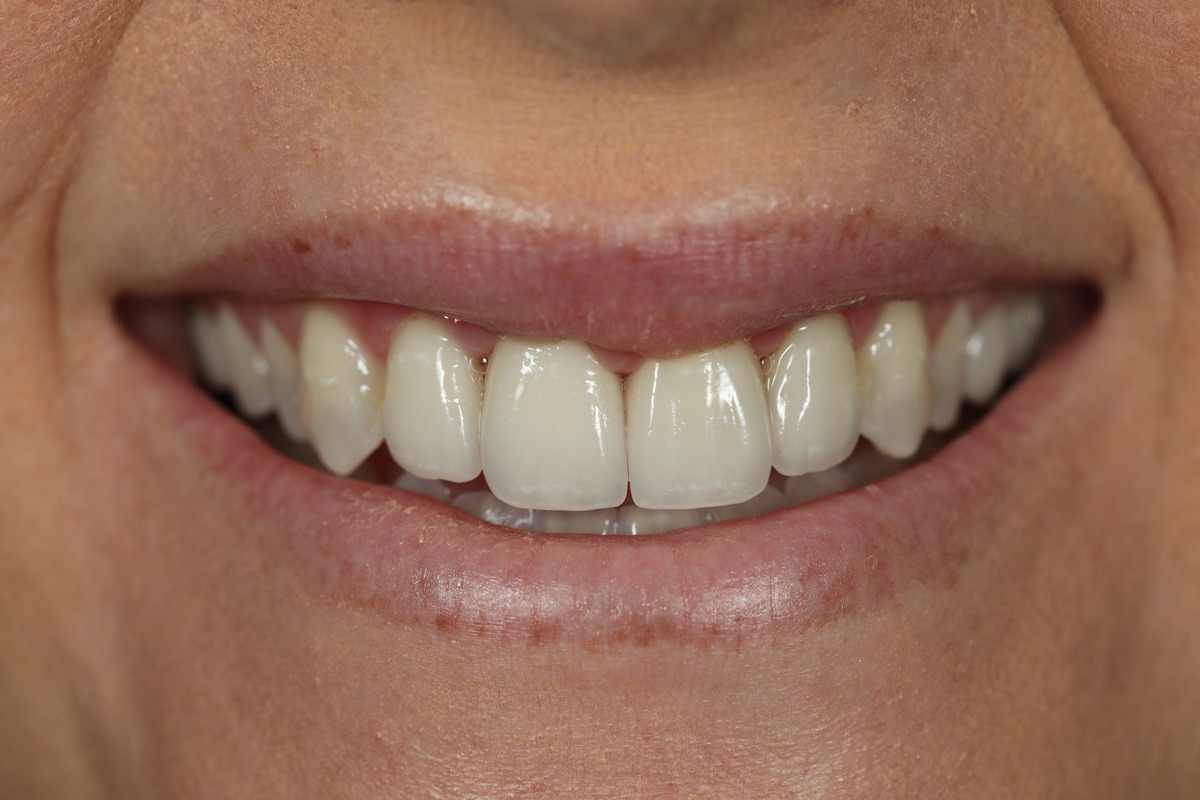 Before & After: Replacing Old Dentistry