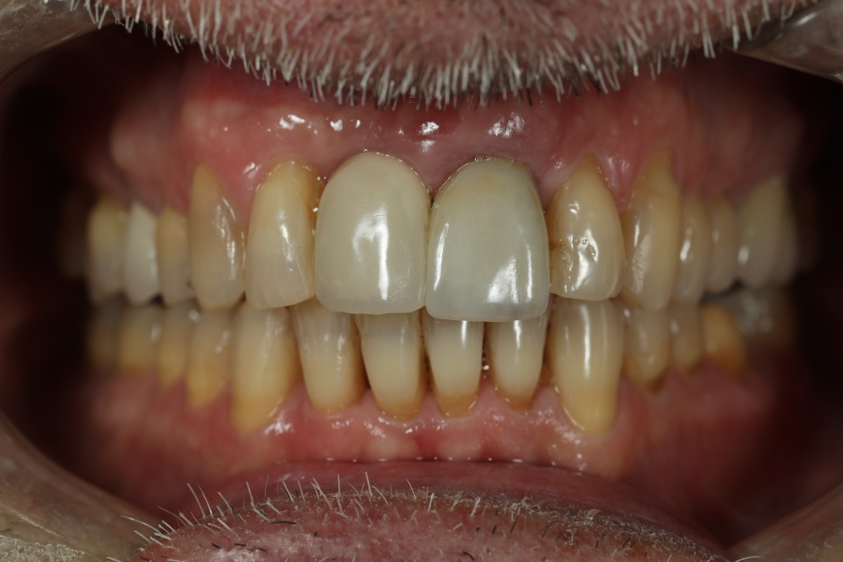 Before & After: Replacing Old Implant Crown