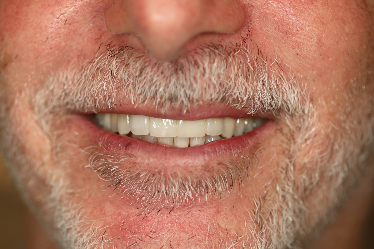 Before & After: Replacing Old Implant Crown