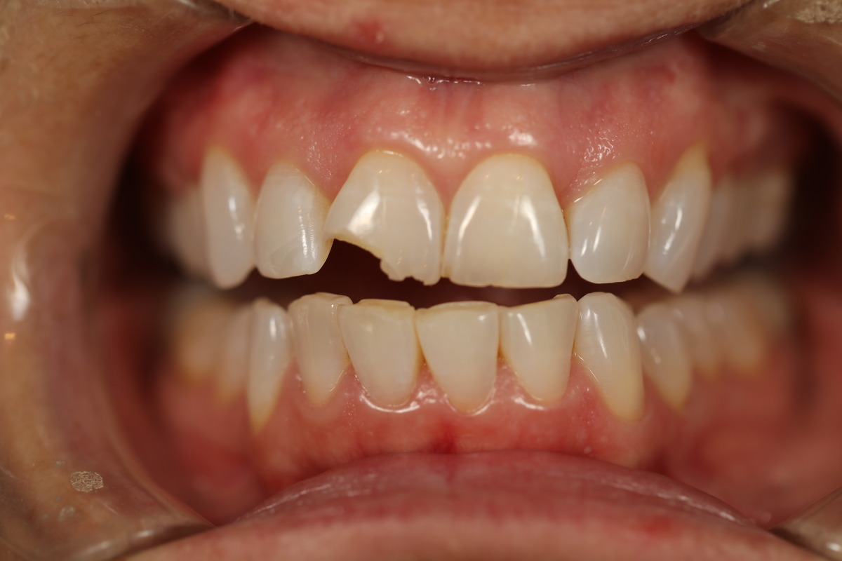 Before & After: Conservative Bonding