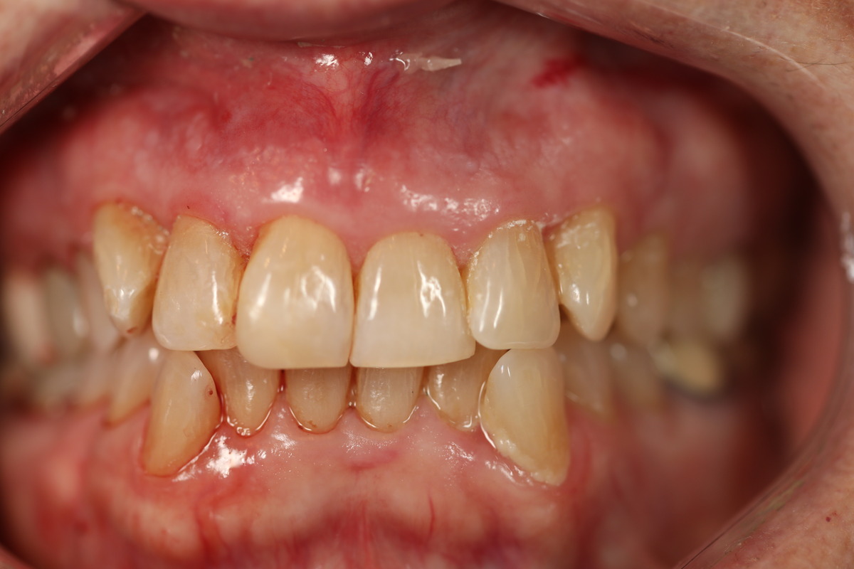 Before & After: Conservative Bonding