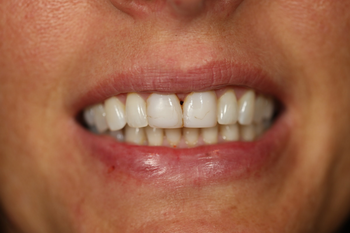 Before & After: Replacing Old Bonding 