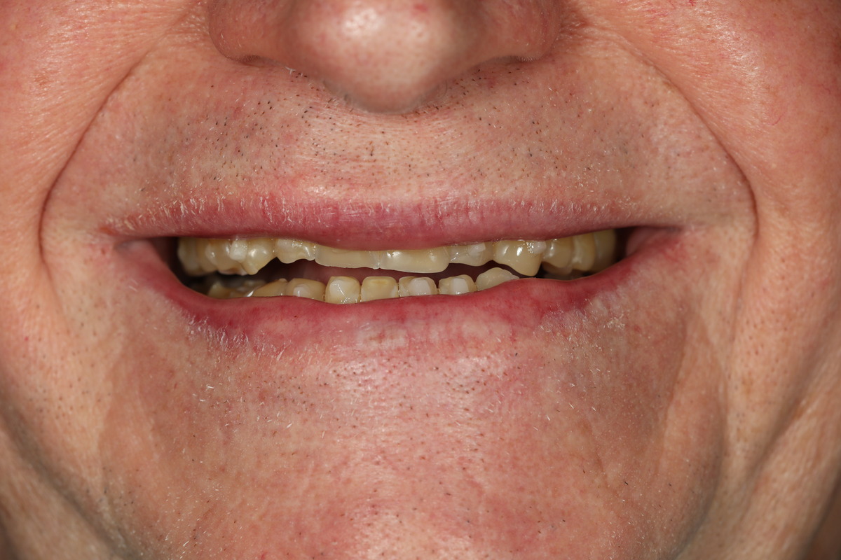 Before & After: Rebuilding A Smile