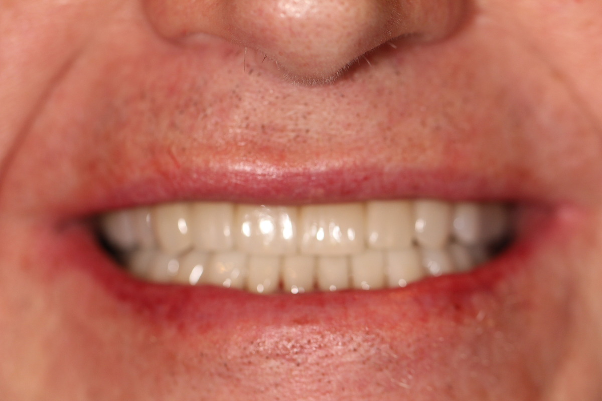 Before & After: Rebuilding A Smile