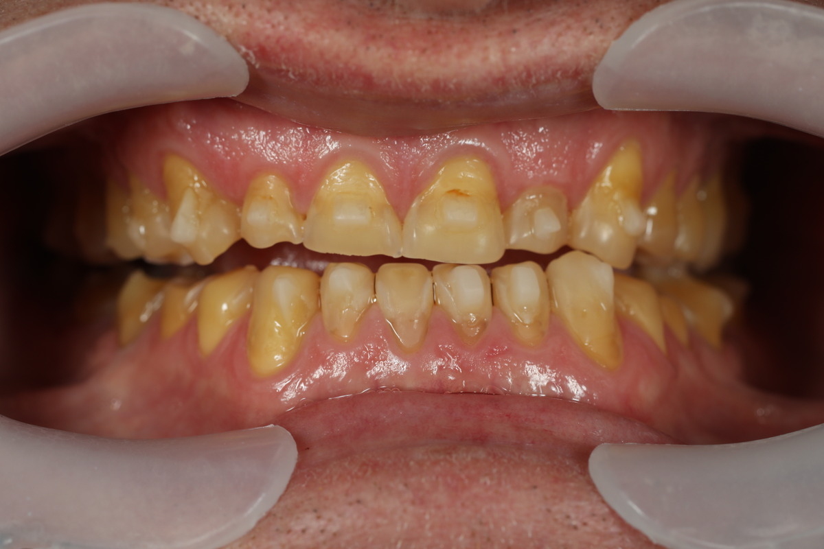 Before & After: Smile Transformation