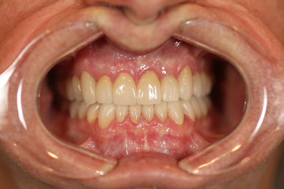 Before & After: New Smile