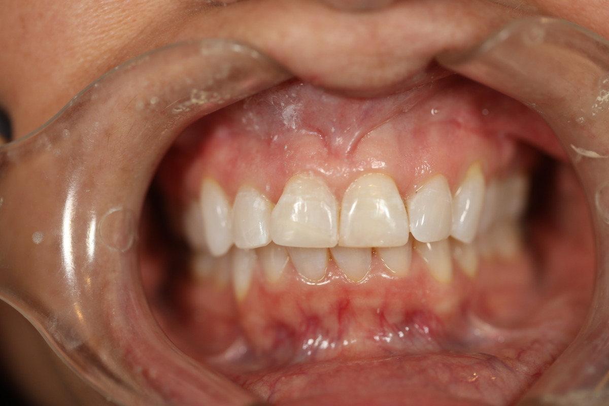 Before & After: Chipped Tooth