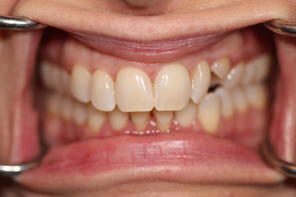 Before & After: Baby Tooth Transformation