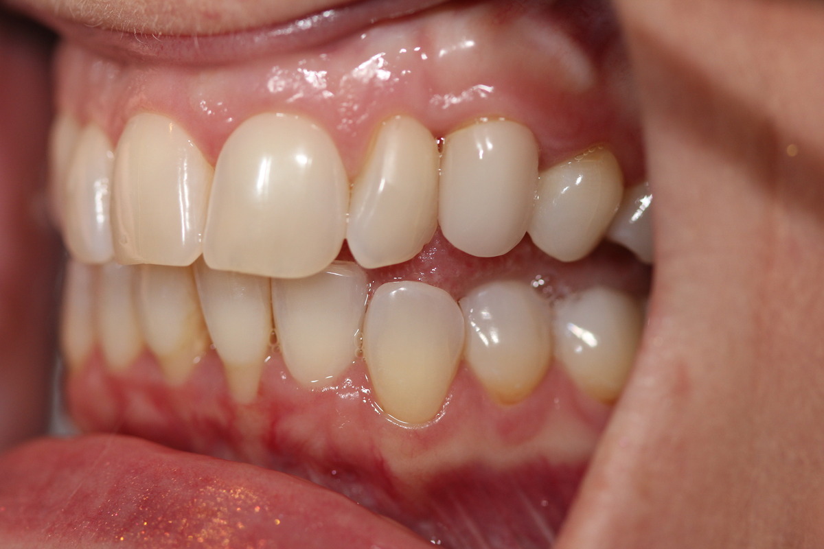 Before & After: Baby Tooth Transformation