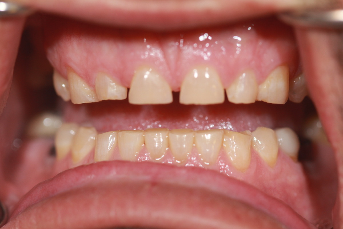 Before & After: Smile Makeover