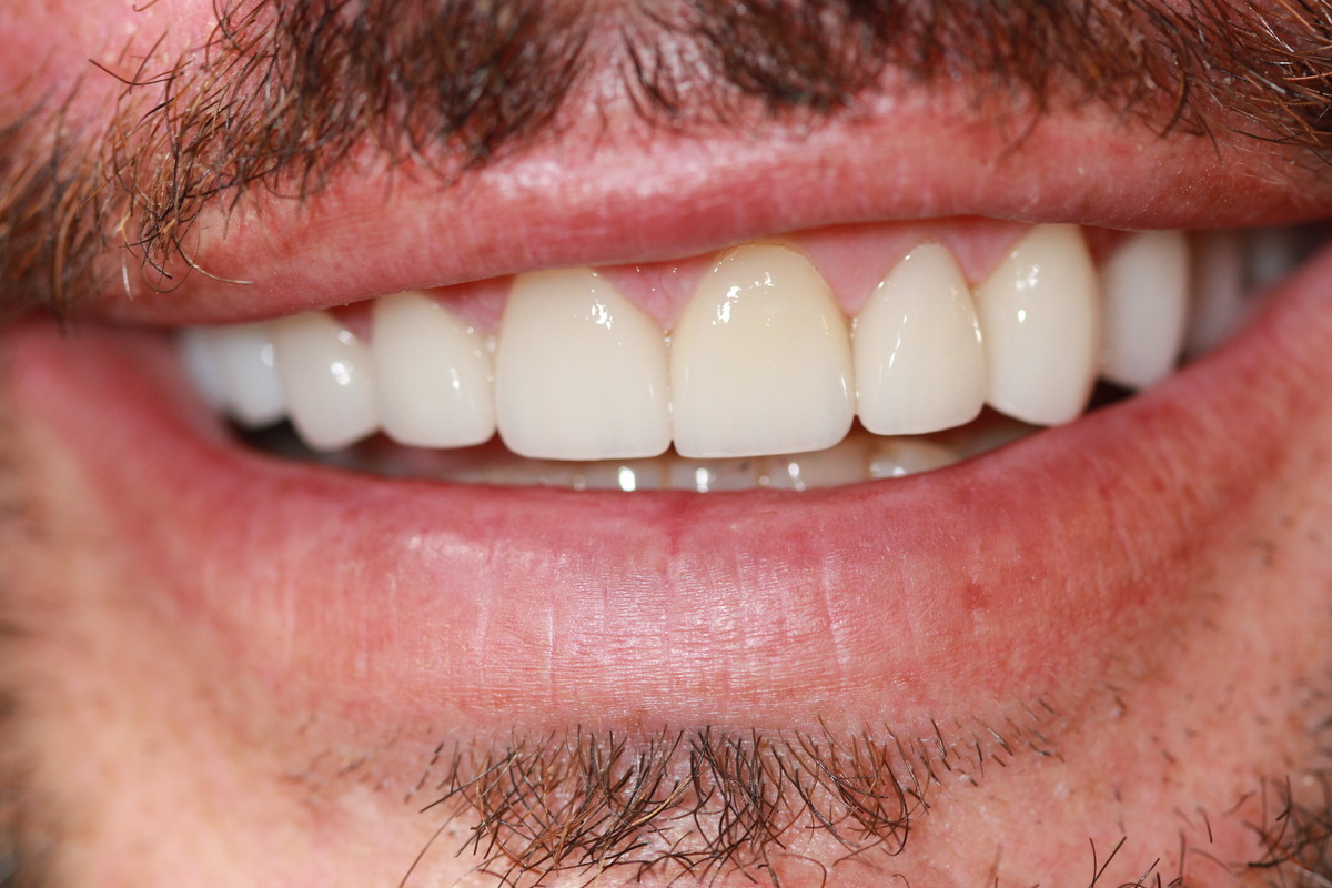 Before & After: Smile Makeover