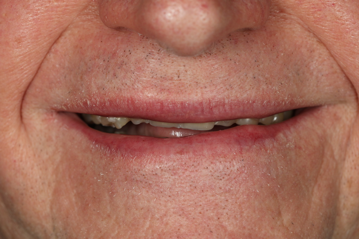 Before & After: Conservative Porcelain