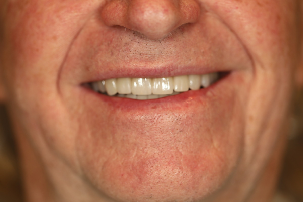 Before & After: Conservative Porcelain