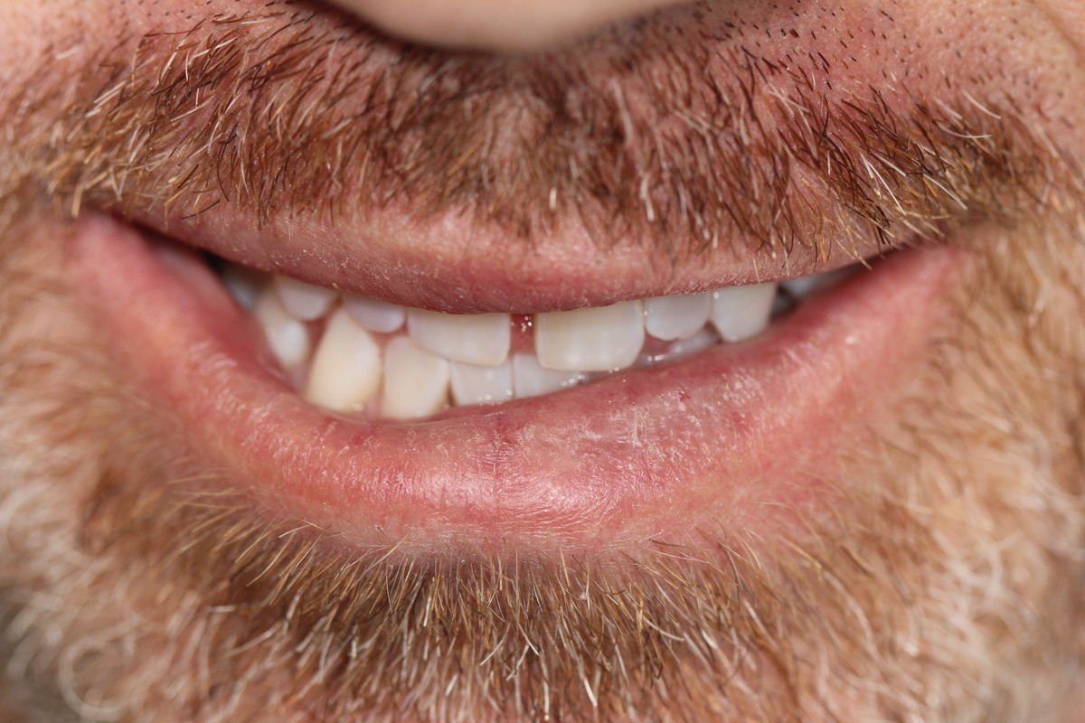 Before & After: Invisalign® Transformation