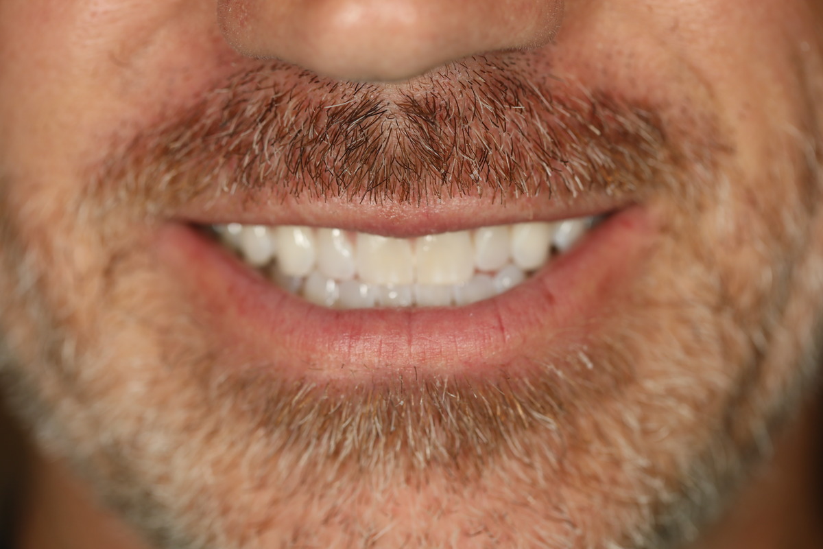 Before & After: Invisalign® Transformation