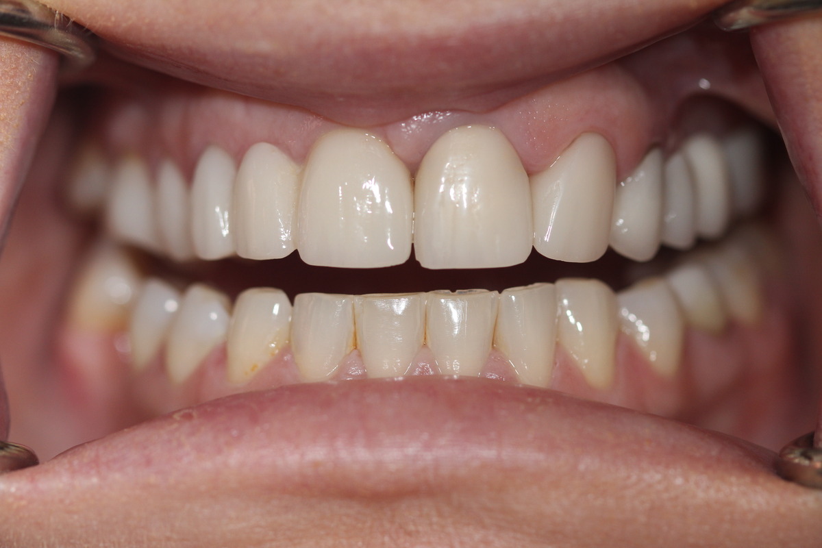 Before & After: Smile Improvement