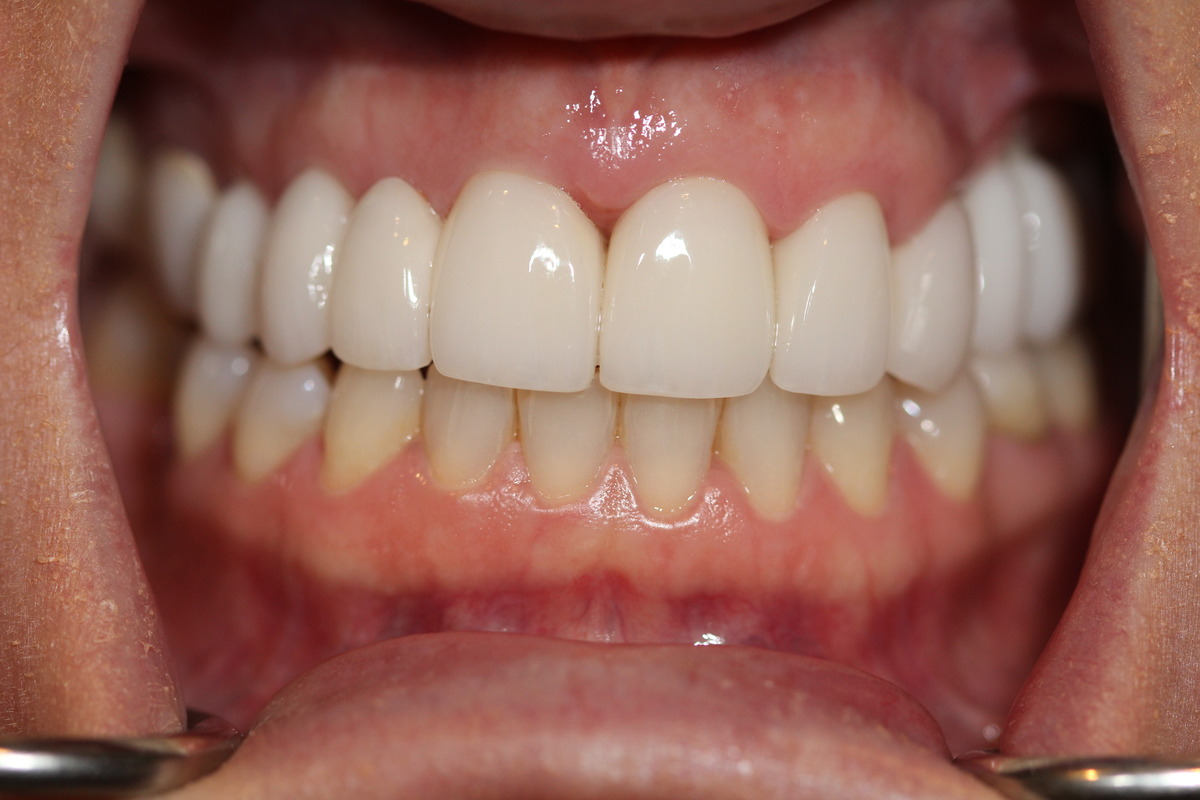 Before & After: Smile Improvement