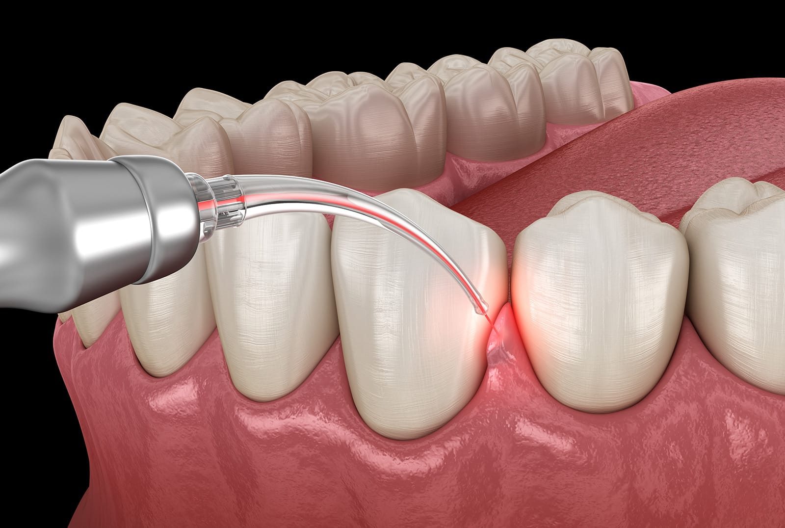 Benefits of Laser Dentistry