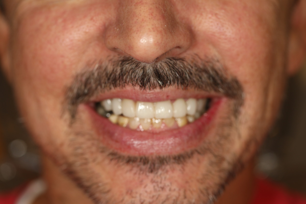 Before & After: A Healthier, Happier Smile!